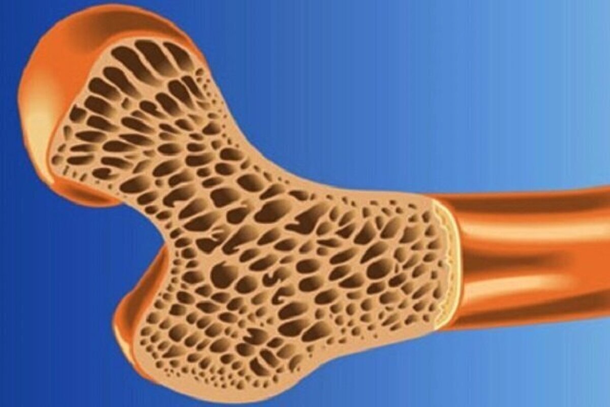 تخمین پوکی استخوان در نیمی از جمعیت کشور | کمبود دستگاه‌های تراکم سنجش استخوان